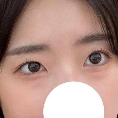 눈밑지방재배치 4주차, 다크서클 사라지고 애굣살까지 생겼어요 사진 3 — 아바성형외과 눈밑지방재배치 후기
