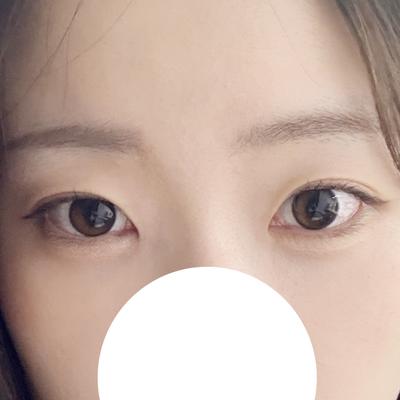 눈밑지방재배치 4주차, 다크서클 사라지고 애굣살까지 생겼어요 사진 4 — 아바성형외과 눈밑지방재배치 후기