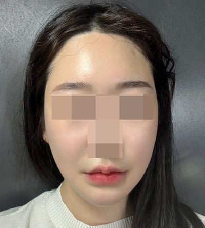 안면거상 환자 후기 — 브라운성형외과 김승수 원장님... (262)