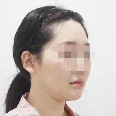 안면거상 12주차, 윤곽까지 같이 하니 효과가 2배예요 사진 3 — 아바성형외과 안면거상 후기