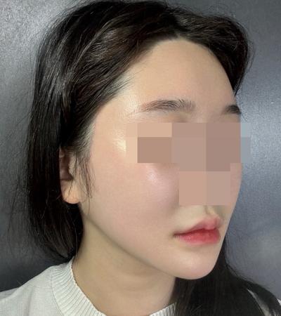 안면거상 12주차, 윤곽까지 같이 하니 효과가 2배예요 사진 5 — 아바성형외과 안면거상 후기