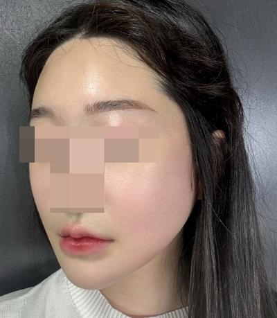 안면거상 12주차, 윤곽까지 같이 하니 효과가 2배예요 사진 6 — 아바성형외과 안면거상 후기