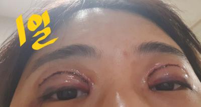 눈성형 환자 후기 — 어제 수술 받았어요 😭
10... (263)