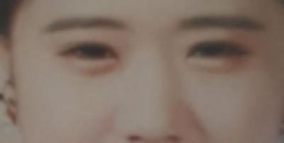 쌍꺼풀 재수술 다음 날, 4년 풀린 눈 드디어 손봤어요 사진 2 — 아바성형외과 쌍꺼풀·눈성형 후기