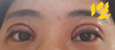 쌍꺼풀 재수술 다음 날, 4년 풀린 눈 드디어 손봤어요 사진 4 — 아바성형외과 쌍꺼풀·눈성형 후기