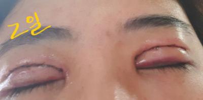 쌍꺼풀 재수술 다음 날, 4년 풀린 눈 드디어 손봤어요 사진 6 — 아바성형외과 쌍꺼풀·눈성형 후기