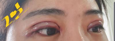 쌍꺼풀 재수술 다음 날, 4년 풀린 눈 드디어 손봤어요 사진 8 — 아바성형외과 쌍꺼풀·눈성형 후기