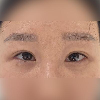 눈밑 수술 4주차, 2주차보다 눈밑이 훨씬 좋아졌어요 — 아바성형외과 환자 후기 사진