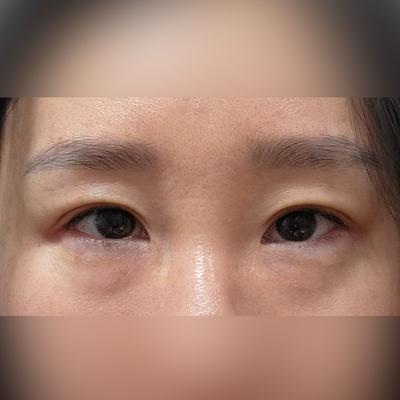눈밑 수술 4주차, 2주차보다 눈밑이 훨씬 좋아졌어요 사진 2 — 아바성형외과 눈밑지방재배치 후기