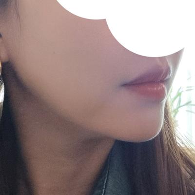 이중턱근육묶기＋지방흡입, 날렵한 턱선 나와서 대만족 — 아바성형외과 환자 후기 사진
