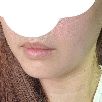 이중턱근육묶기＋지방흡입, 날렵한 턱선 나와서 대만족 사진 2 — 아바성형외과 이중턱·윤곽 후기