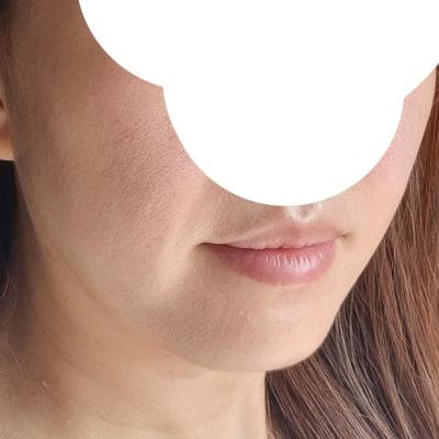 이중턱근육묶기＋지방흡입, 날렵한 턱선 나와서 대만족 사진 3 — 아바성형외과 이중턱·윤곽 후기