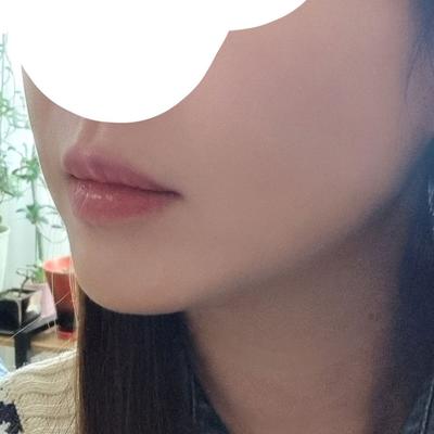 이중턱근육묶기＋지방흡입, 날렵한 턱선 나와서 대만족 사진 4 — 아바성형외과 이중턱·윤곽 후기