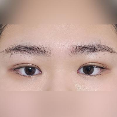매몰 쌍꺼풀 2달차, 눈 커지고 화장도 잘 먹어서 만족해요 — 아바성형외과 환자 후기 사진