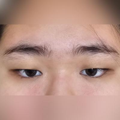 매몰 쌍꺼풀 2달차, 눈 커지고 화장도 잘 먹어서 만족해요 사진 2 — 아바성형외과 쌍꺼풀·눈성형 후기