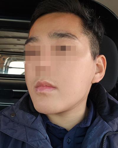 얼굴지방흡입·이중턱근육묶기 4주차, 턱선 진짜 날렵해졌어요 — 아바성형외과 환자 후기 사진
