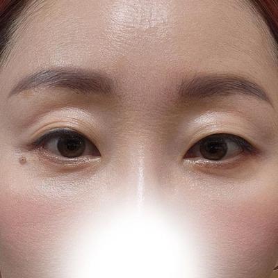 눈밑처짐 수술 8주차, 눈밑 확실히 개선됐어요 — 아바성형외과 환자 후기 사진