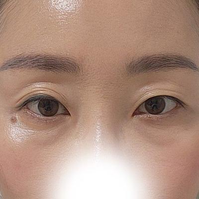 눈밑처짐 수술 8주차, 눈밑 확실히 개선됐어요 사진 2 — 아바성형외과 눈밑지방재배치 후기