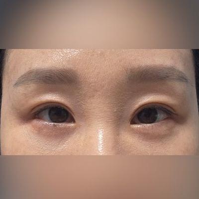눈밑지방재배치 6주차, 몽고주름도 자연스러워졌어요 — 아바성형외과 환자 후기 사진