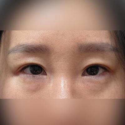 눈밑지방재배치 6주차, 몽고주름도 자연스러워졌어요 사진 2 — 아바성형외과 눈밑지방재배치 후기