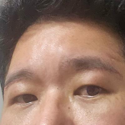 아바성형외과 김승수 원장님 수술 6주차, 완전 만족해요 — 아바성형외과 환자 후기 사진