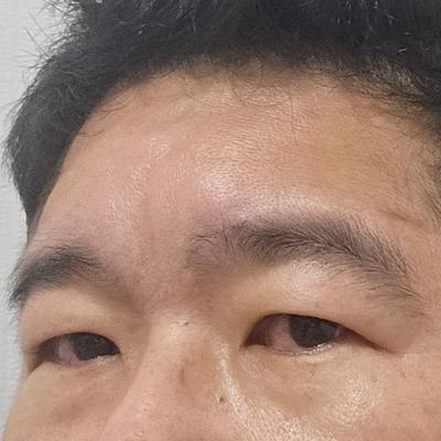 아바성형외과 김승수 원장님 수술 6주차, 완전 만족해요 사진 2 — 아바성형외과 기타 후기