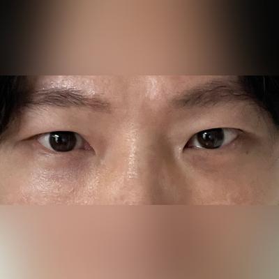 눈밑지방재배치 2주차, 짝짝이 눈밑이 매끈해지고 눈가가 환해졌어요 — 아바성형외과 환자 후기 사진