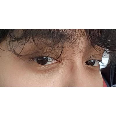 눈밑지방재배치 6주차, 피곤해 보이던 눈이 사라졌어요 — 아바성형외과 환자 후기 사진