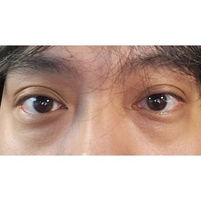 눈밑지방재배치 6주차, 피곤해 보이던 눈이 사라졌어요 사진 2 — 아바성형외과 눈밑지방재배치 후기