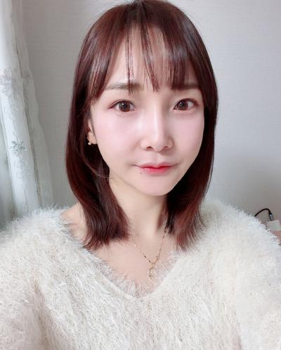 눈성형 환자 후기 — 눈밑 주름 꺼짐때문에 고민하... (274)