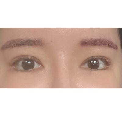 처진 눈 수술 6주차, 언제 처졌는지 모를만큼 또렷해졌어요 — 아바성형외과 환자 후기 사진