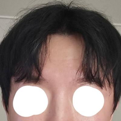이마거상술 8주차, 주름 스트레스 사라지고 자연스러워요 — 아바성형외과 환자 후기 사진