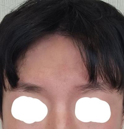 수술 6주차 사진, 생기 있고 어려 보인다는 말 들어요 — 아바성형외과 환자 후기 사진