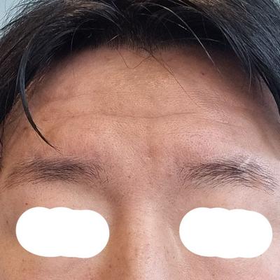 수술 6주차 사진, 생기 있고 어려 보인다는 말 들어요 사진 2 — 아바성형외과 기타 후기