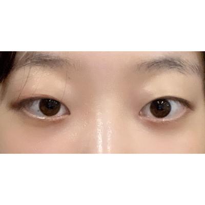 김승수 원장님께 수술받고 4주차, 너무 만족스러워요 — 아바성형외과 환자 후기 사진