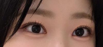 비절개 쌍꺼풀＋앞트임 8주차, 속쌍 라인 확 높였어요 — 아바성형외과 환자 후기 사진