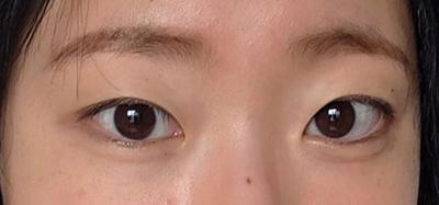비절개 쌍꺼풀＋앞트임 8주차, 속쌍 라인 확 높였어요 사진 2 — 아바성형외과 쌍꺼풀·눈성형 후기