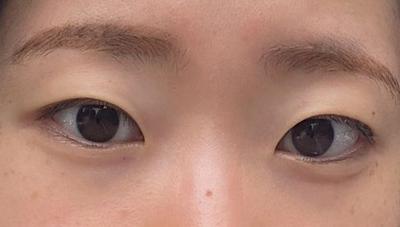 비절개 쌍꺼풀＋앞트임 8주차, 속쌍 라인 확 높였어요 사진 3 — 아바성형외과 쌍꺼풀·눈성형 후기