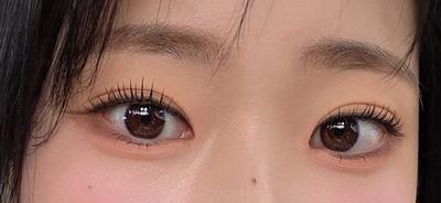 비절개 쌍꺼풀＋앞트임 8주차, 속쌍 라인 확 높였어요 사진 4 — 아바성형외과 쌍꺼풀·눈성형 후기