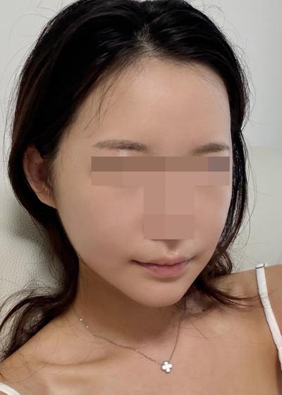 윤곽3종＋안면거상 아큐 3주차, 벌써 얼굴 작아진 게 보여요 사진 4 — 아바성형외과 안면거상 후기