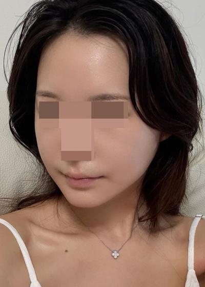 윤곽3종＋안면거상 아큐 3주차, 벌써 얼굴 작아진 게 보여요 사진 5 — 아바성형외과 안면거상 후기