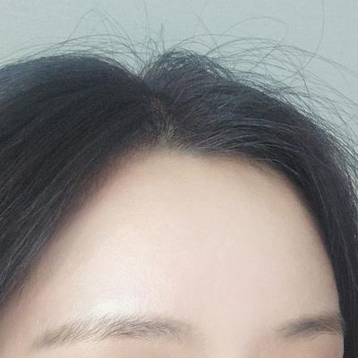 이마지방이식 6주차, 옆모습 예뻐졌다는 말 많이 들어요 — 아바성형외과 환자 후기 사진