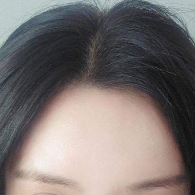 이마지방이식 6주차, 옆모습 예뻐졌다는 말 많이 들어요 사진 4 — 아바성형외과 이마거상 후기