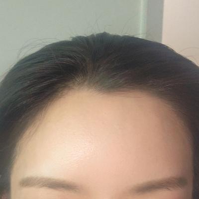 이마지방이식 4주차, 티 안 나게 예뻐졌다는 말 들어요 — 아바성형외과 환자 후기 사진