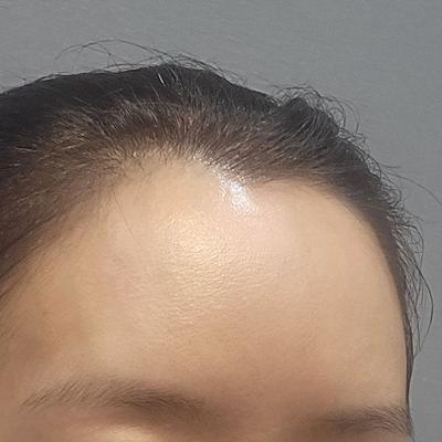 이마지방이식 4주차, 티 안 나게 예뻐졌다는 말 들어요 사진 2 — 아바성형외과 이마거상 후기