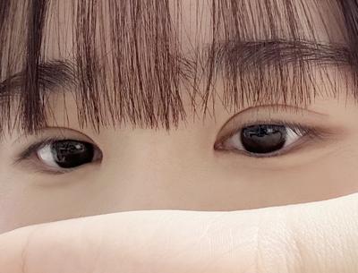 절개 쌍꺼풀＋윗트임 한달차, 눈 뜨기 편하고 라인 깔끔해요 — 아바성형외과 환자 후기 사진
