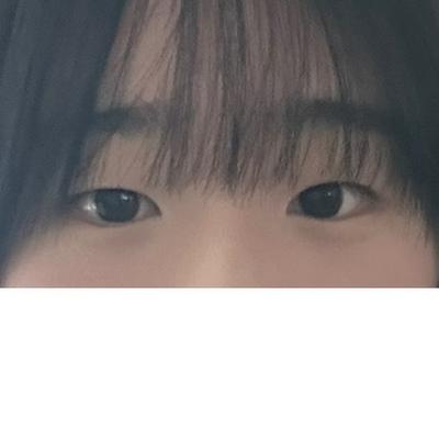 절개 쌍꺼풀＋윗트임 한달차, 눈 뜨기 편하고 라인 깔끔해요 사진 2 — 아바성형외과 쌍꺼풀·눈성형 후기
