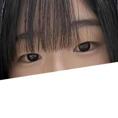 절개 쌍꺼풀＋윗트임 한달차, 눈 뜨기 편하고 라인 깔끔해요 사진 3 — 아바성형외과 쌍꺼풀·눈성형 후기
