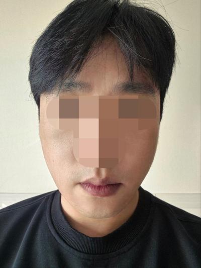 이마거상 6주차, 이마주름 90프로 사라지고 눈썹도 올라갔어요 — 아바성형외과 환자 후기 사진