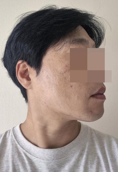 이마거상 6주차, 이마주름 90프로 사라지고 눈썹도 올라갔어요 사진 3 — 아바성형외과 안면거상 후기